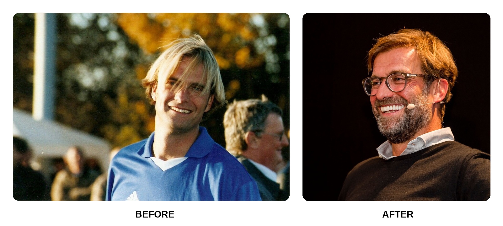 What happened to Jurgen Klopp’s teeth?