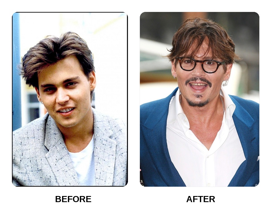 Did Johnny Depp get his teeth done?