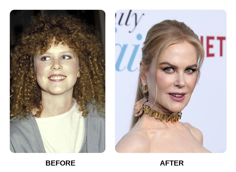 What happened to Nicole Kidman teeth?