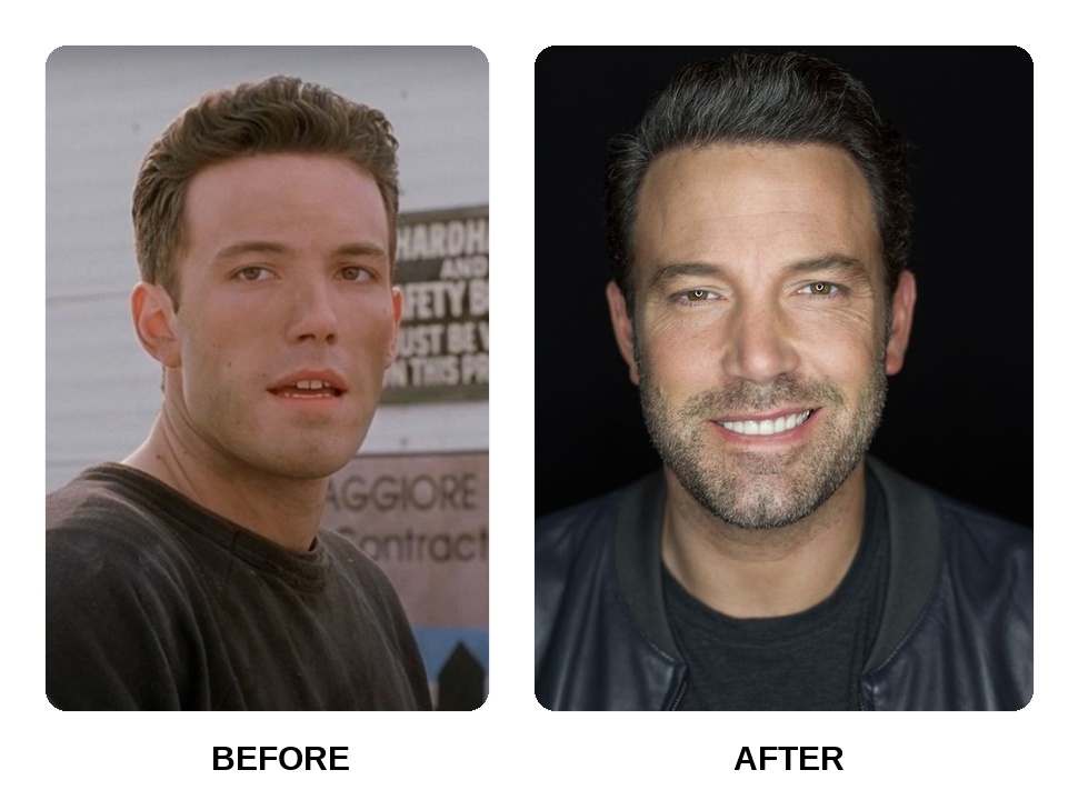 What happened to Ben Affleck teeth?