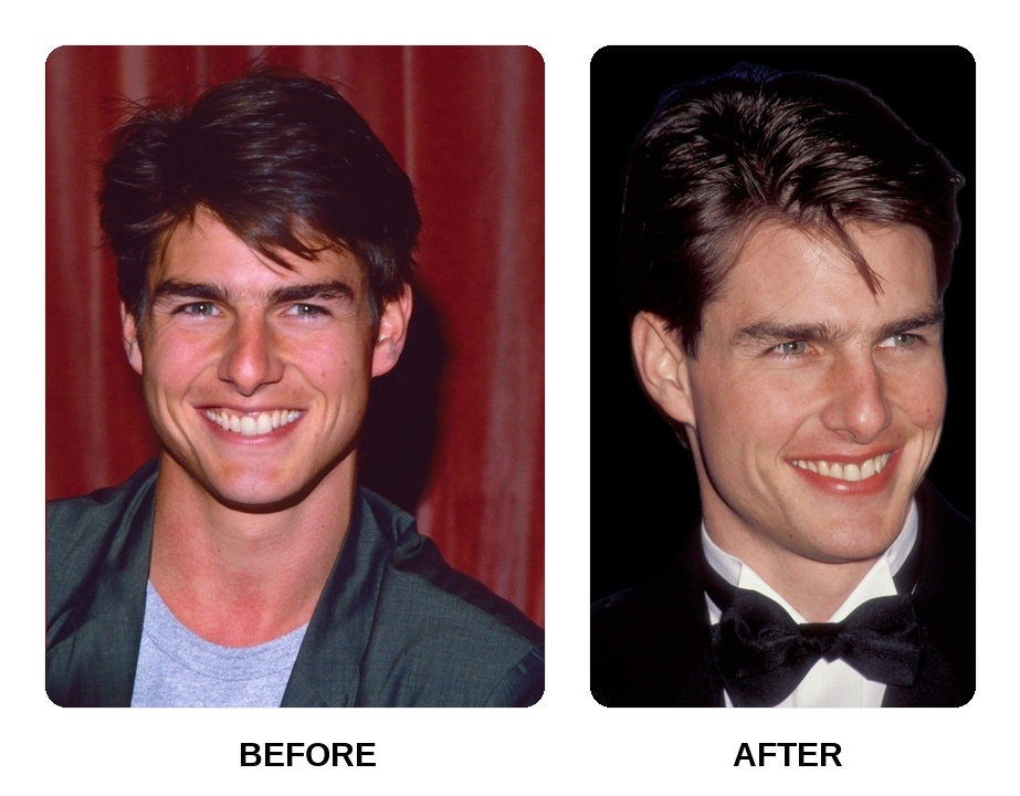 Did Tom Cruise Get His Teeth Done?