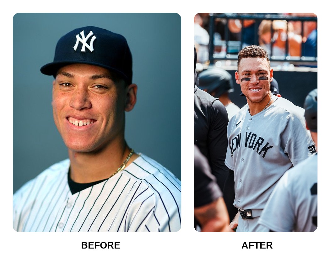 Aaron Judge Teeth Before and After: What Happened in His Transformation?