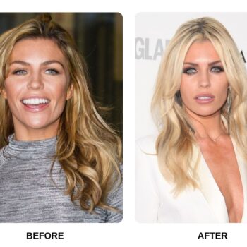 Abbey Clancy Teeth Before and After: What Happened in Her Transformation?