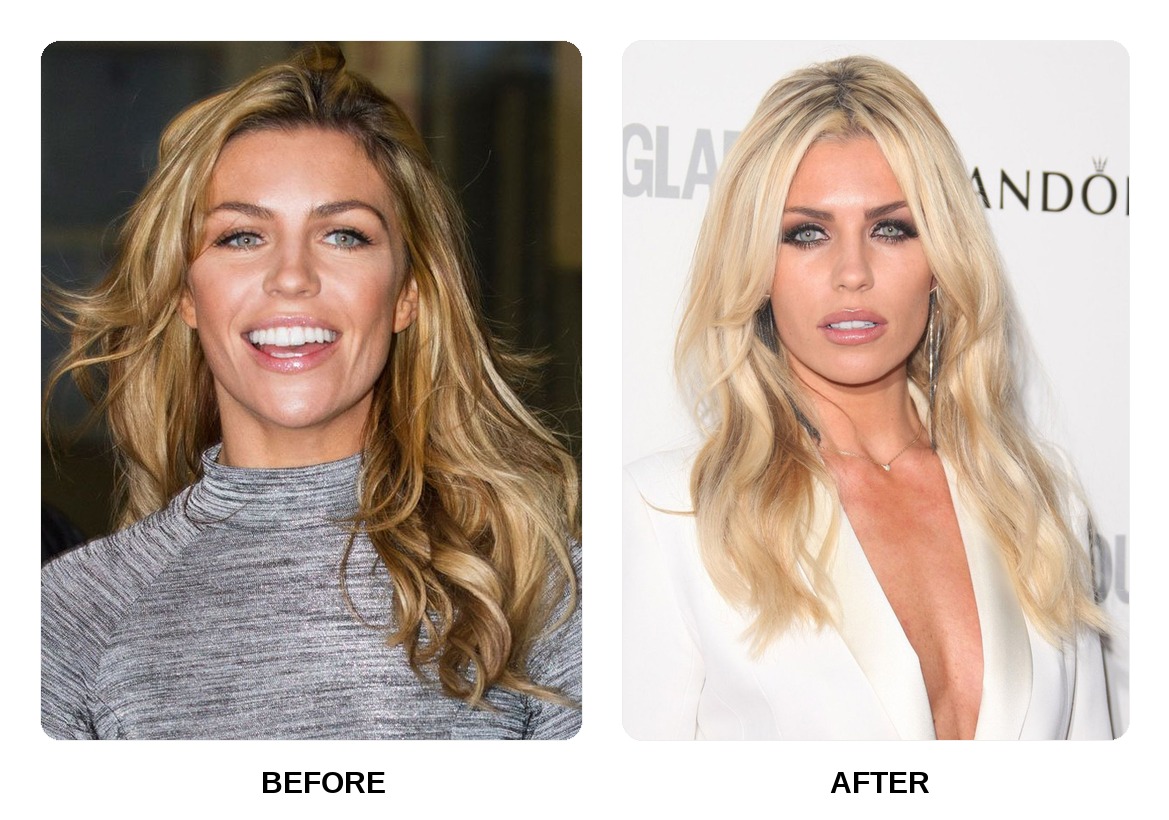 Abbey Clancy Teeth Before and After: What Happened in Her Transformation?