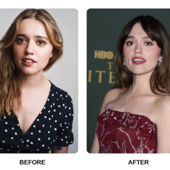 Aimee Lou Wood Teeth Before and After: What Happened in His Transformation?