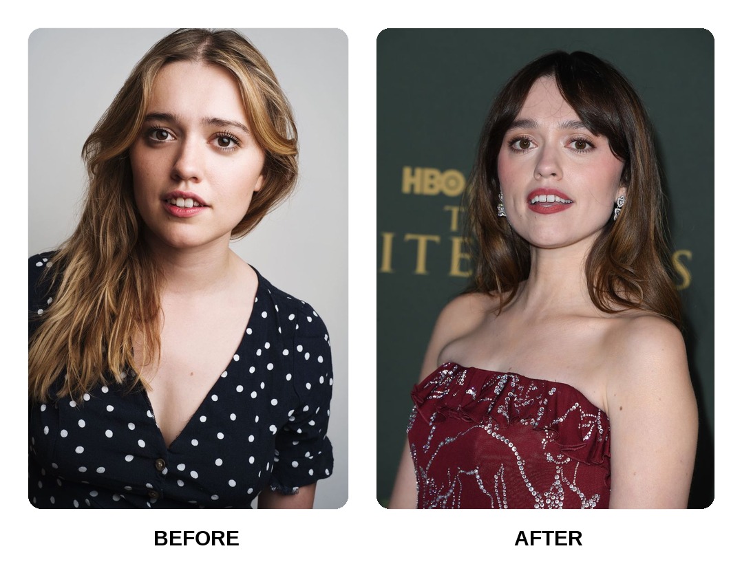 Aimee Lou Wood Teeth Before and After: What Happened in His Transformation?