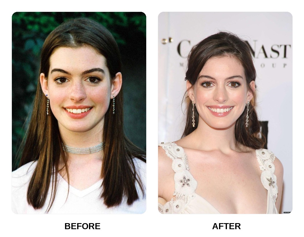 Anne Hathaway Teeth Before and After: What Happened in Her Transformation?