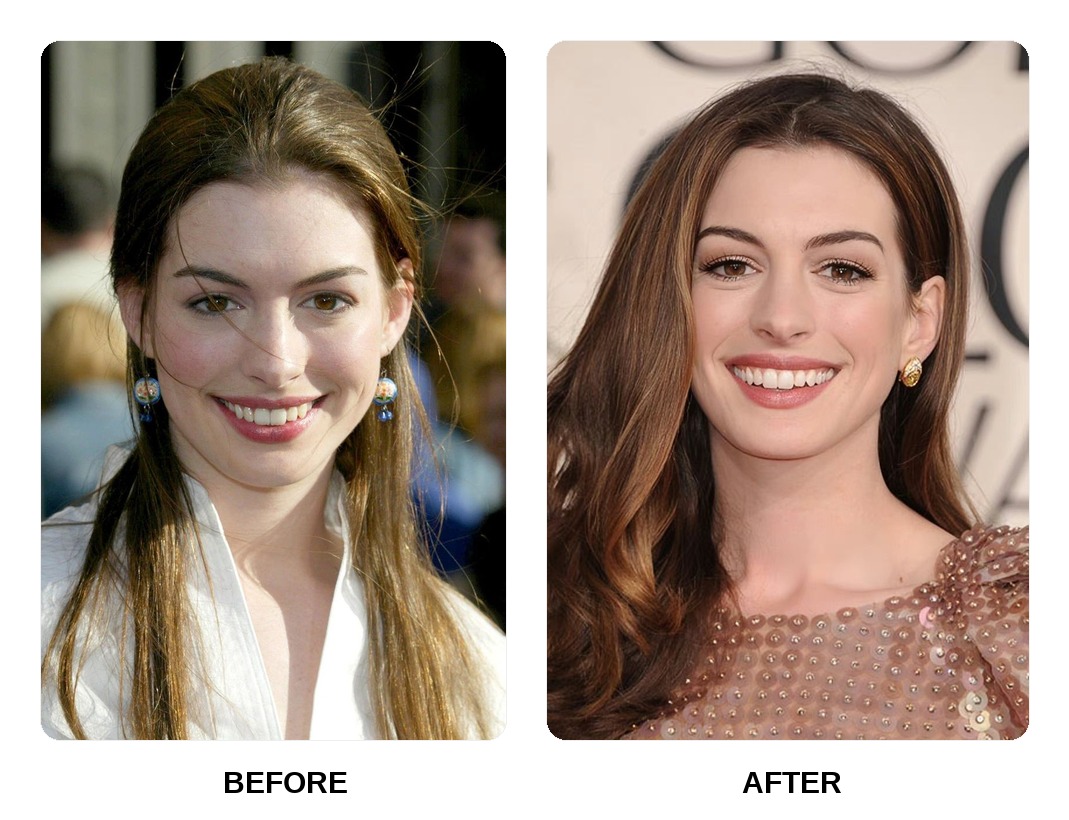 Anne Hathaway teeth in her youth