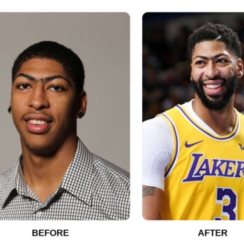 Anthony Davis Teeth Before and After: What Happened in His Transformation?