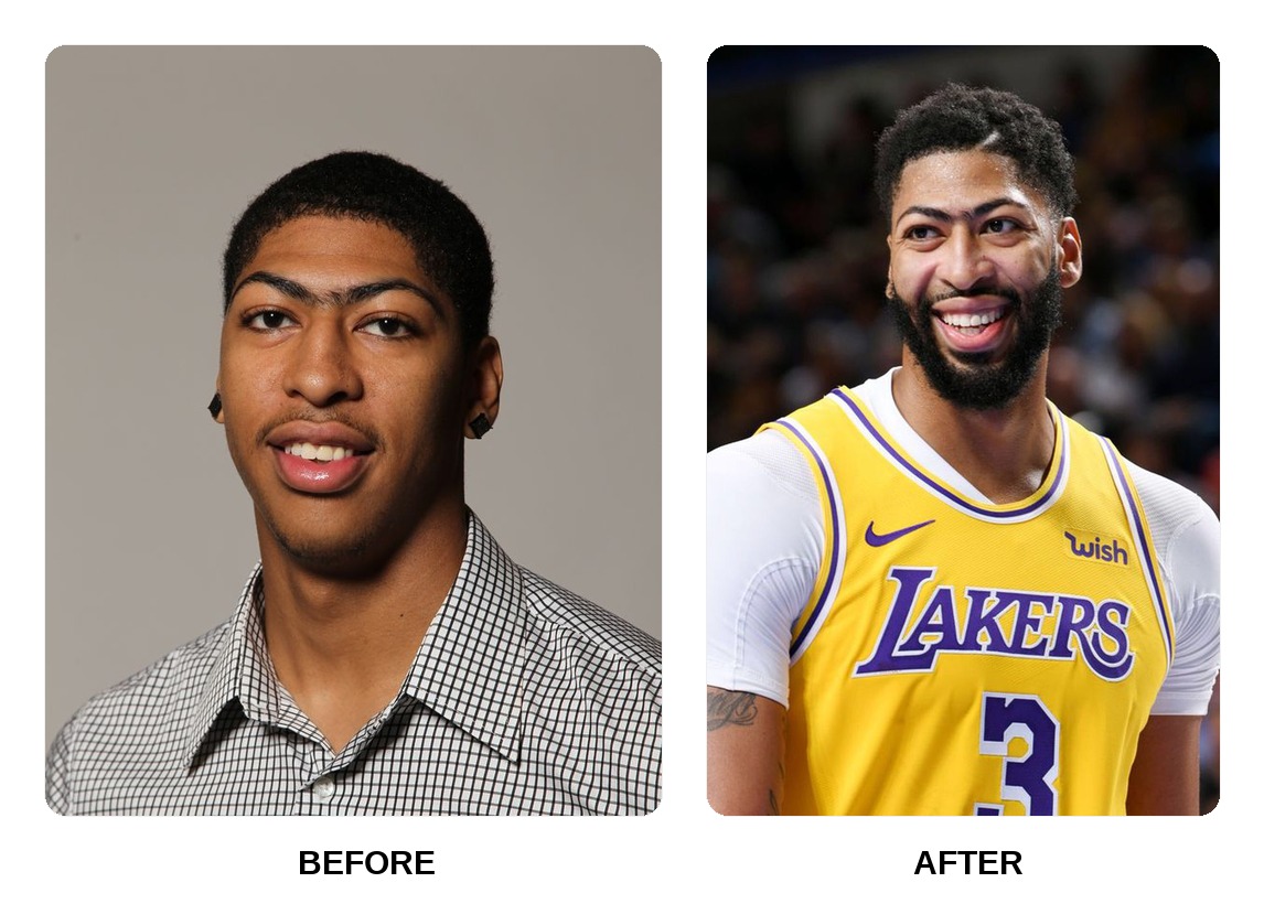 Anthony Davis Teeth Before and After: What Happened in His Transformation?
