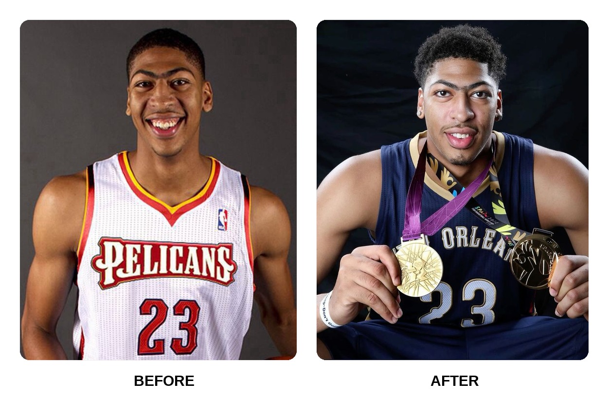 Anthony Davis teeth in his youth