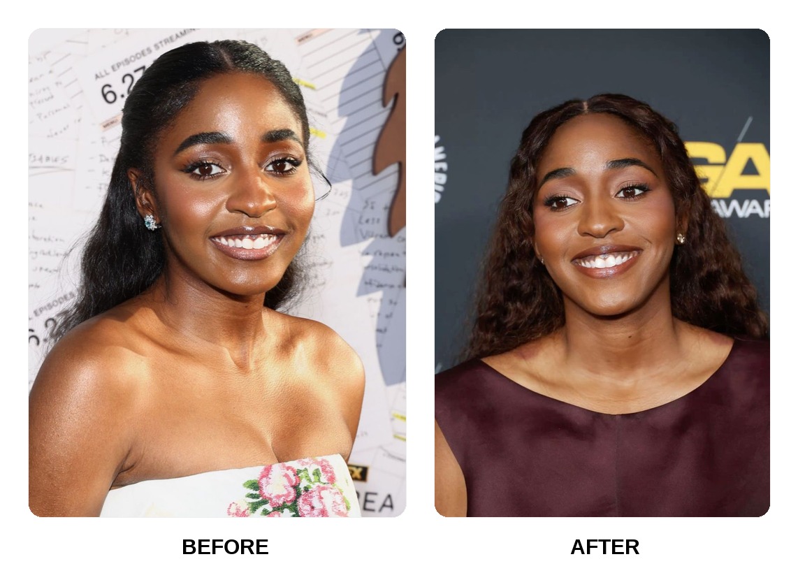 Ayo Edebiri Teeth Before and After: What Happened in His Transformation?