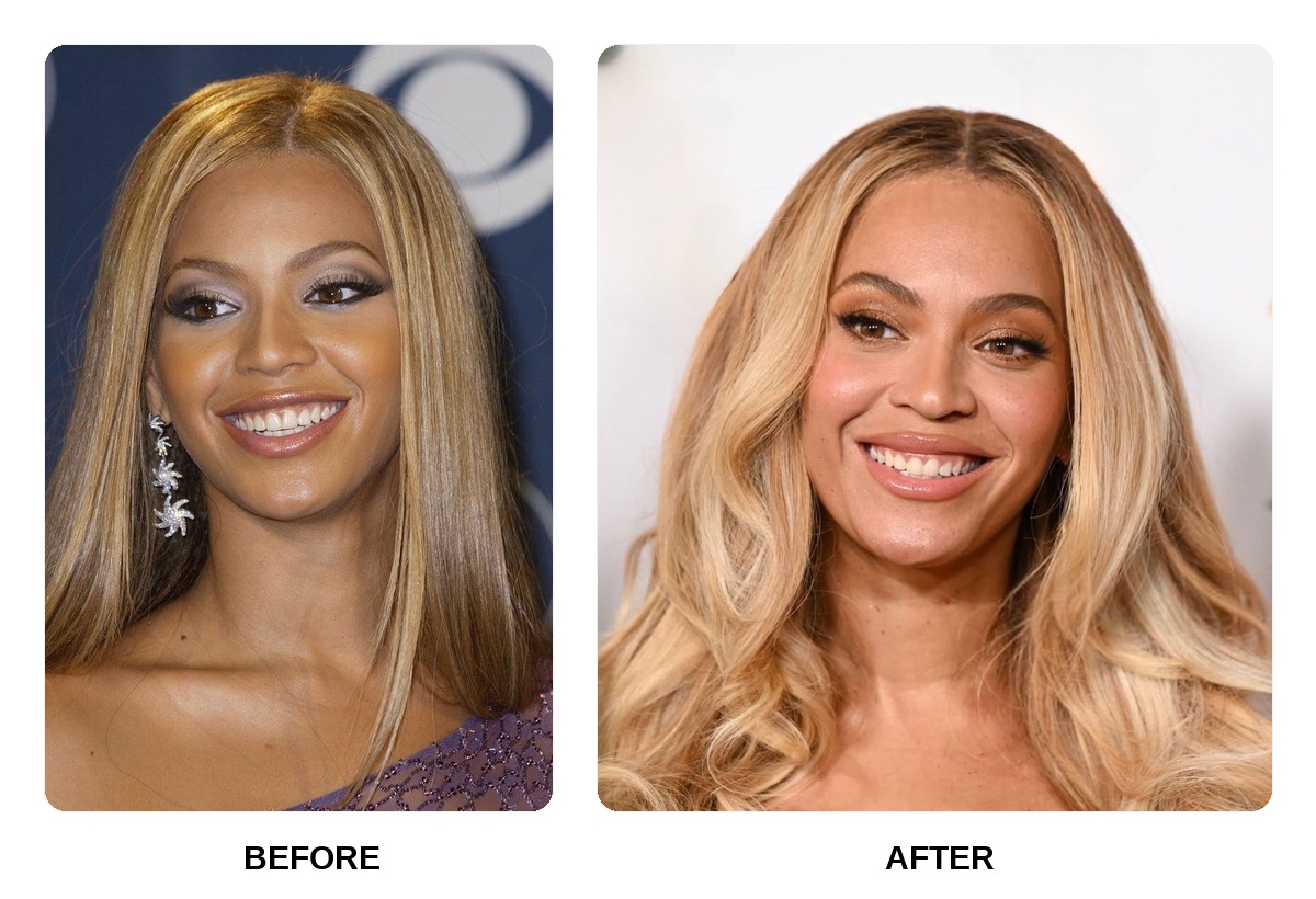 Beyonce Teeth Before and After: What Happened in Her Transformation?