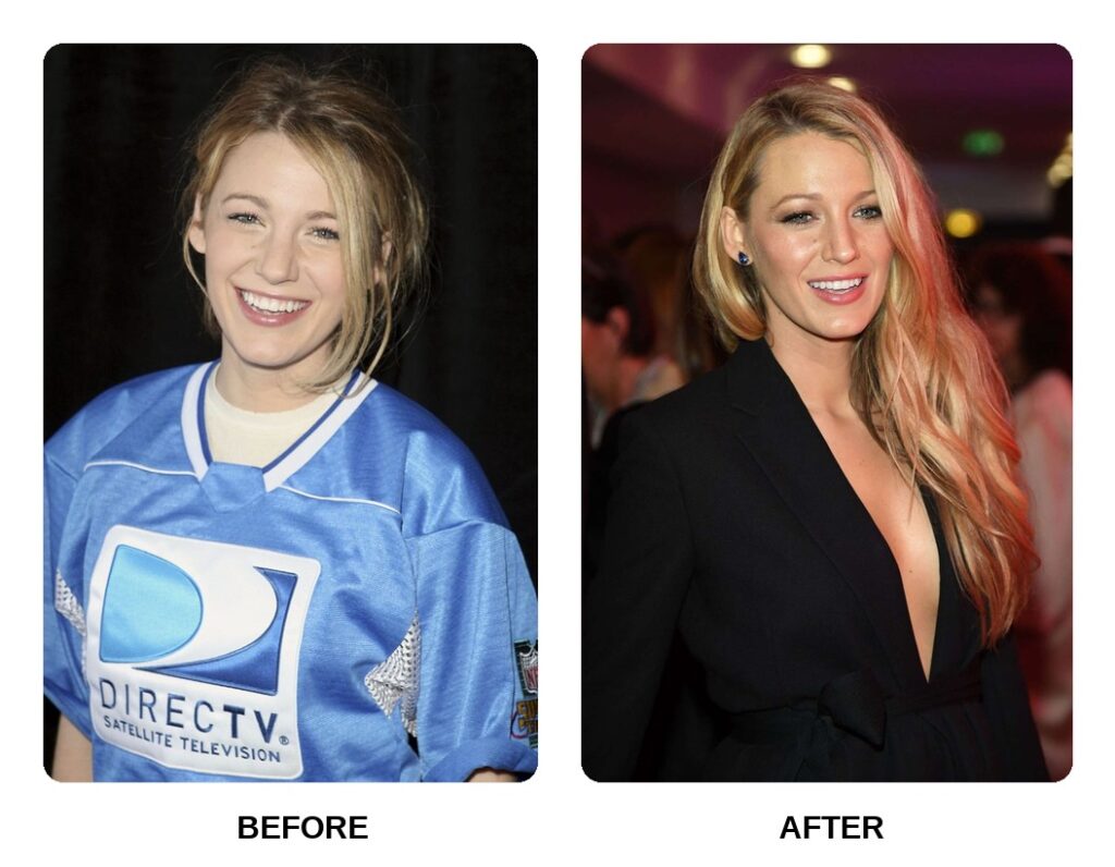 Blake Lively Teeth Before and After: What Happened in Her Transformation?