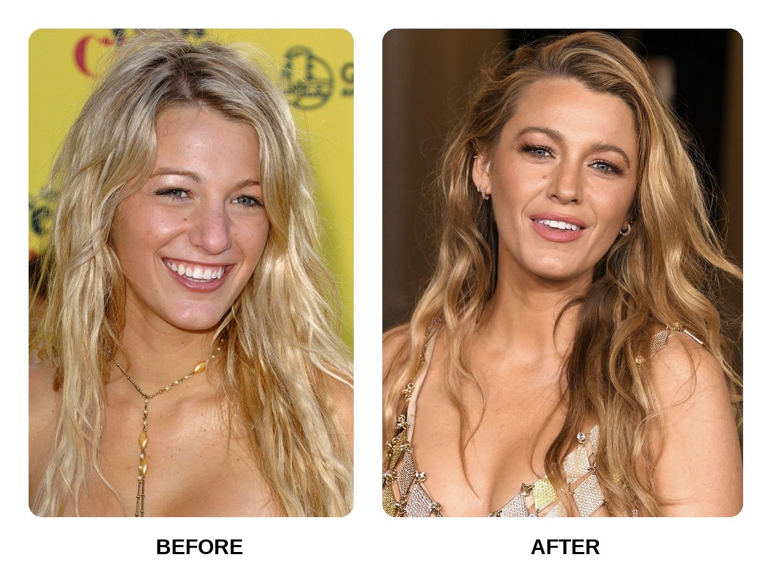 Blake Lively teeth in her youth