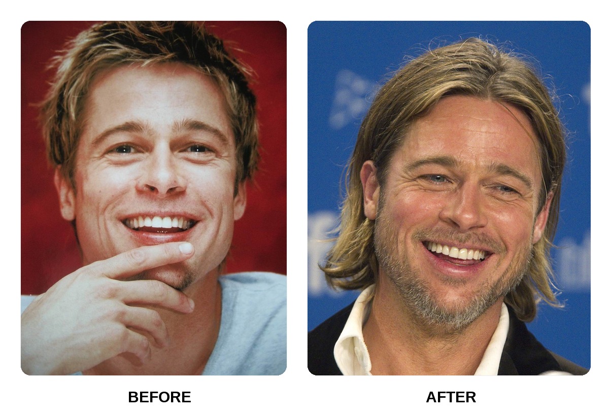 Brad Pitt Teeth Before and After: What Happened in His Transformation?
