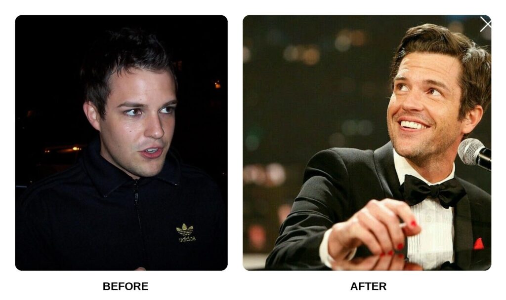 Brandon Flowers Teeth Before and After: What Happened in His Transformation?