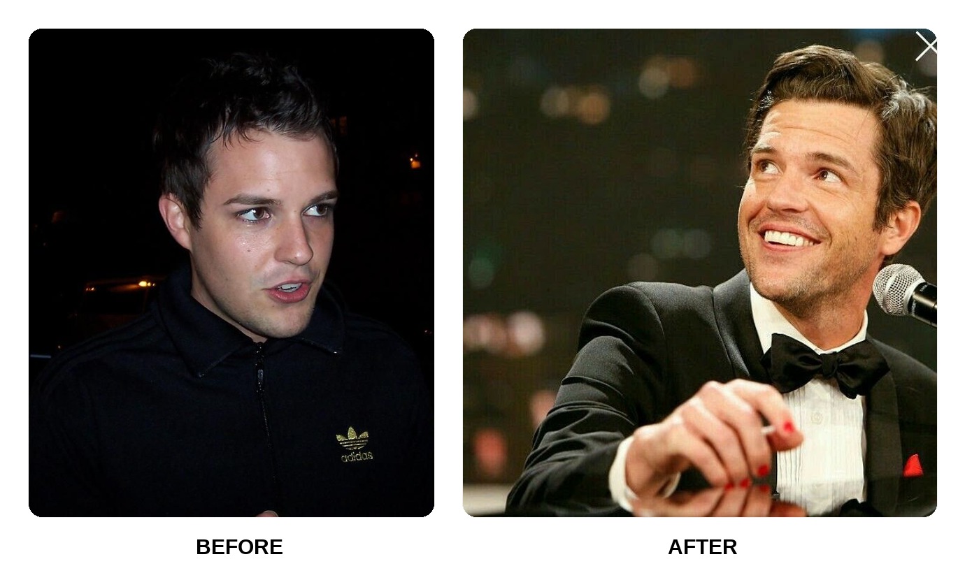 Brandon Flowers Teeth Before and After: What Happened in His Transformation?