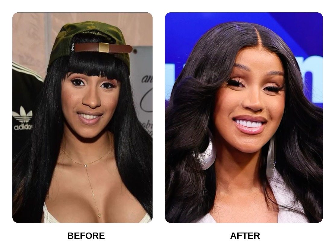 Cardi B Teeth Before and After: What Happened in Her Transformation?
