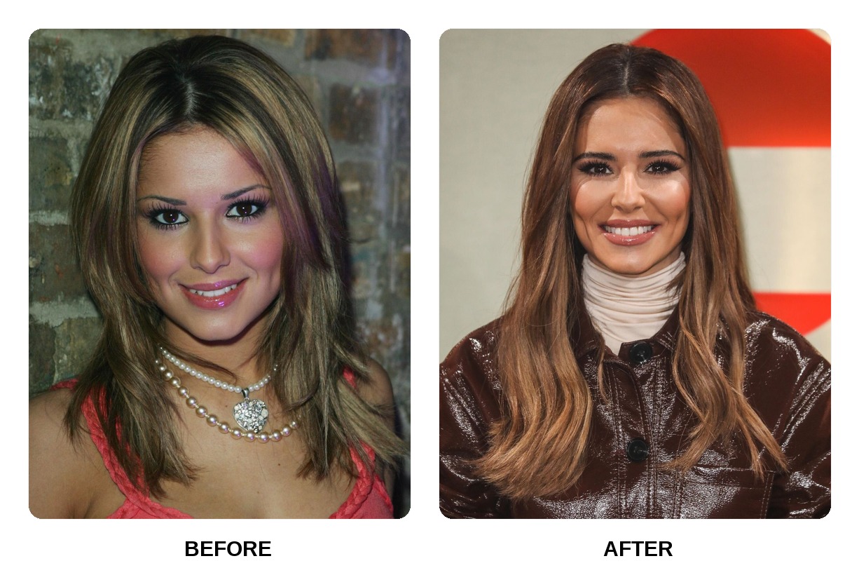 Cheryl Cole Teeth Before and After: What Happened in Her Transformation?