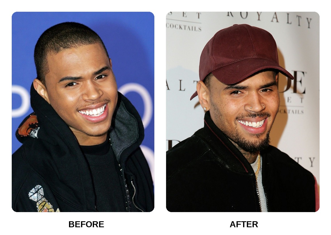 Chris Brown Teeth Before and After: What Happened in His Transformation?