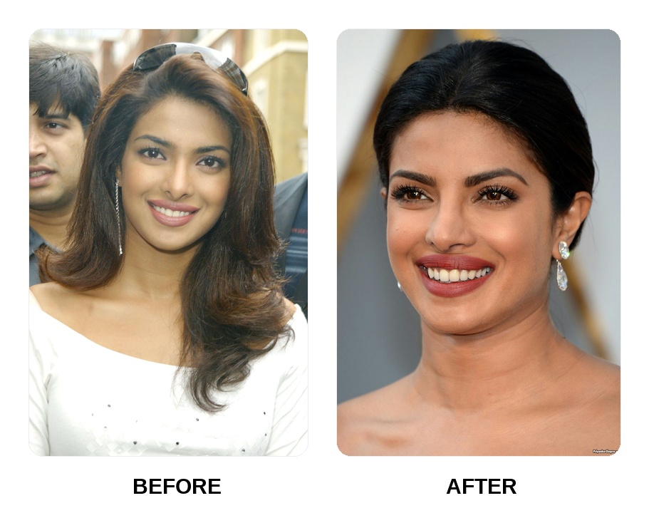 Priyanka Chopra Teeth Before and After: What Happened in Her Transformation?
