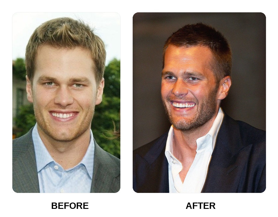 Tom Brady Teeth Before and After: What Happened in Her Transformation?