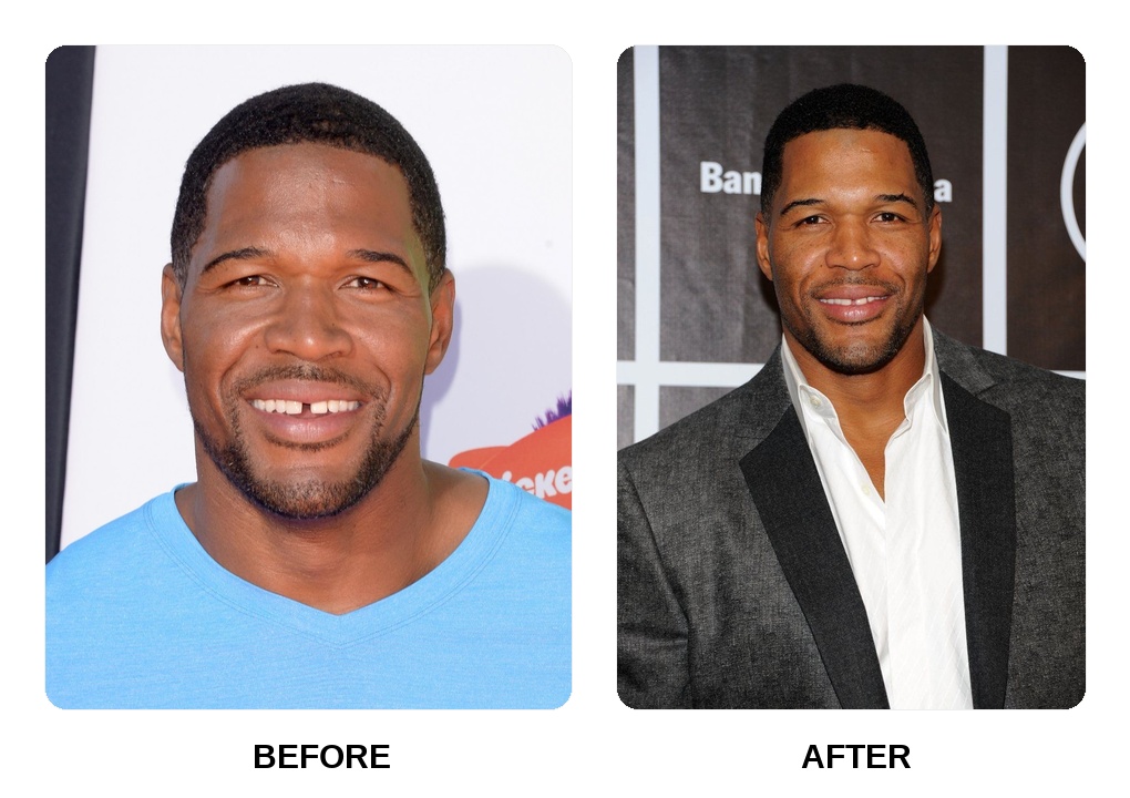Michael Strahan Teeth Before and After: What Happened in His Transformation?