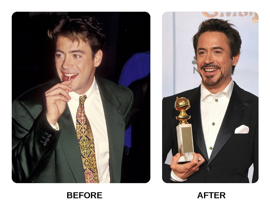 Robert Downey Jr. Teeth Before and After: What Happened in Her Transformation?