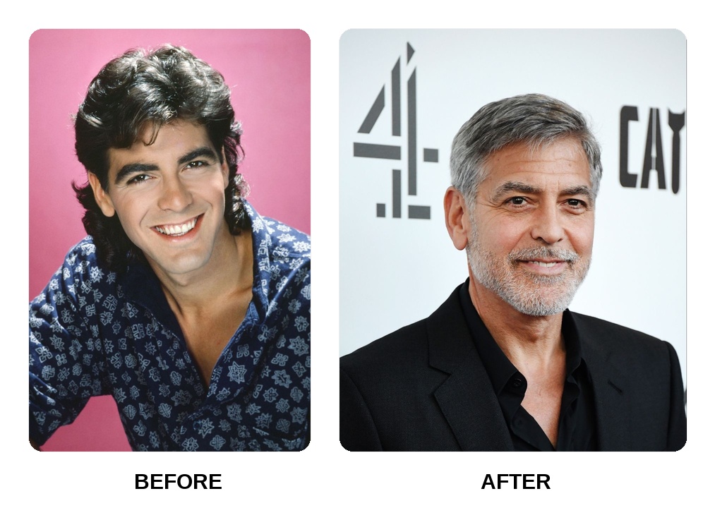 George Clooney Teeth Before and After: What Happened in His Transformation?