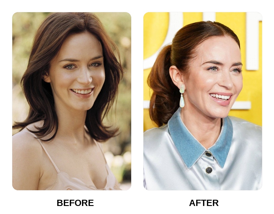 Emily Blunt’s Dental Transformation and Smile