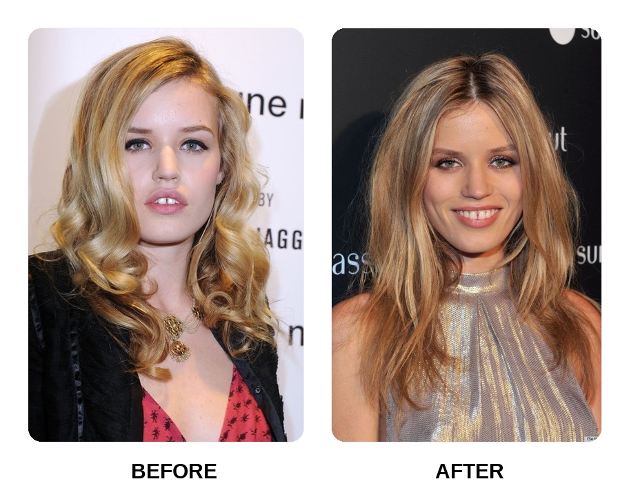 Georgia May Jagger Teeth Before and After: What Happened in Her Transformation?