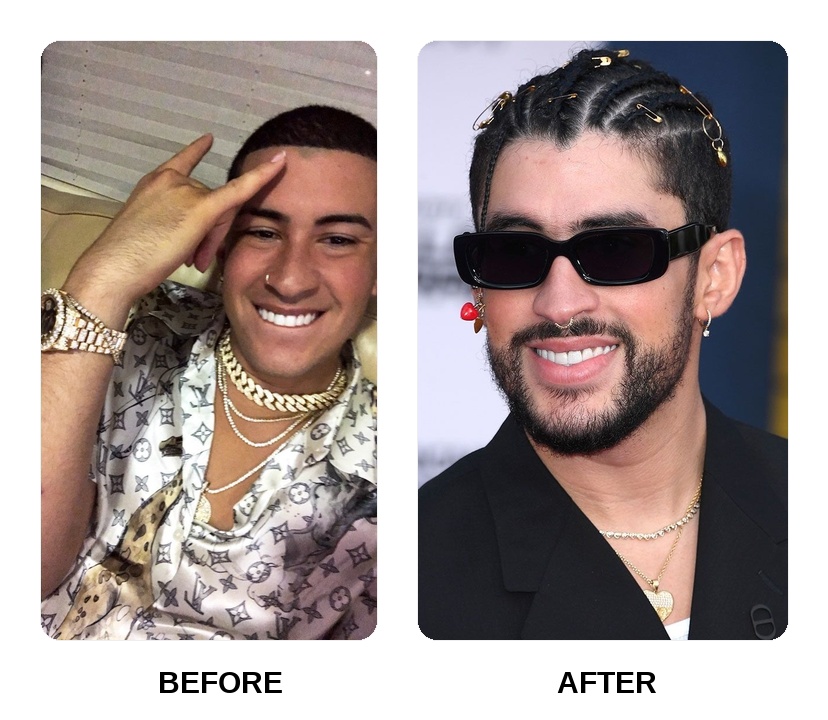 Bad Bunny Teeth Before and After: What Happened in His Transformation?