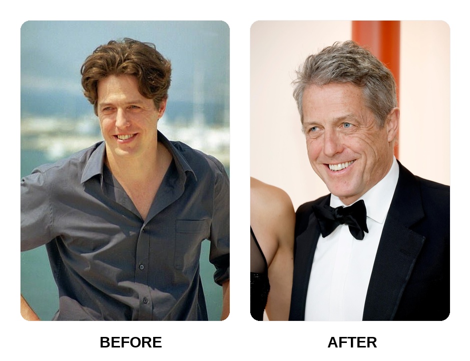 Hugh Grant Teeth Before and After: What Happened in His Transformation?