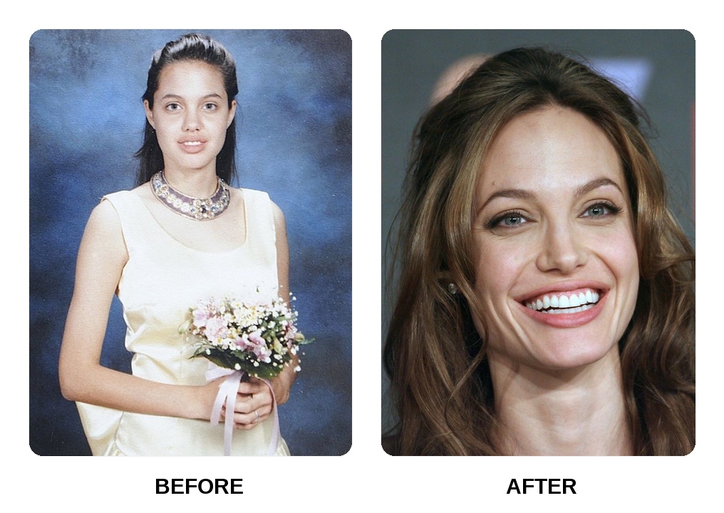 Angelina Jolie Teeth Before and After: What Happened in Her Transformation?