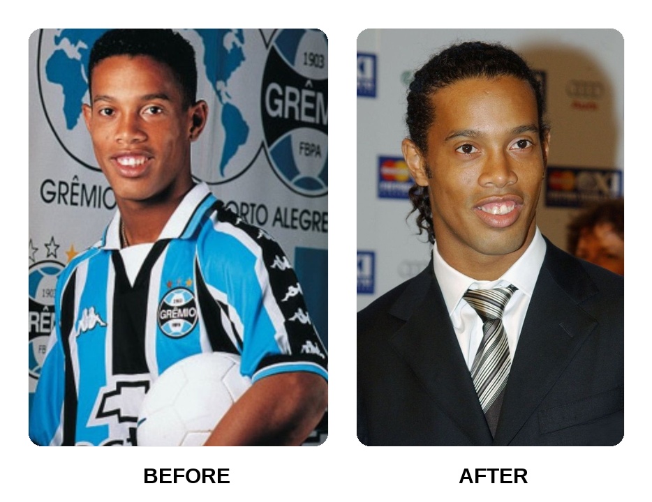 Ronaldinho Teeth Before and After: What Happened in His Transformation?
