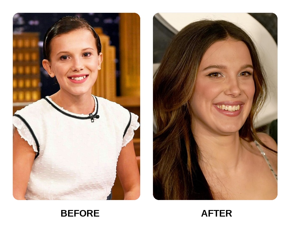 Millie Bobby Brown Teeth Before and After: What Happened in Her Transformation?