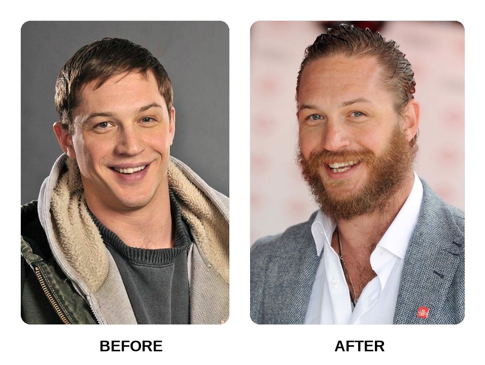 Tom Hardy Teeth Before and After: What Happened in His Transformation?