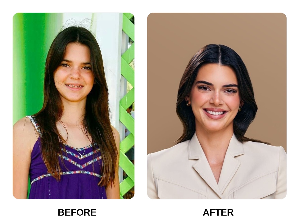Kendall Jenner Teeth Before and After: What Happened in Her Transformation?