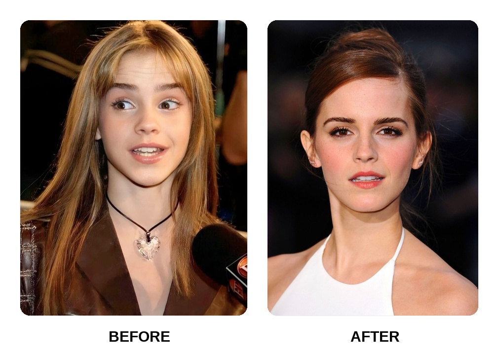 Emma Watson Teeth Before and After: What Happened in Her Transformation?