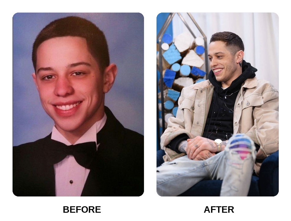 Pete Davidson Teeth Before and After: What Happened in His Transformation?