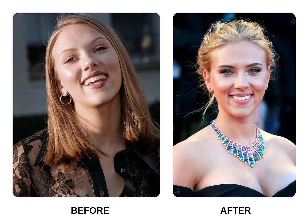 Scarlett Johansson Teeth Before and After: What Happened in Her Transformation?