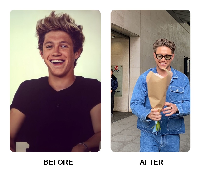 Niall Horan Teeth Before and After: What Happened in His Transformation?