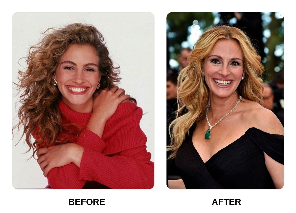 Julia Roberts Teeth Before and After: What Happened in Her Transformation?