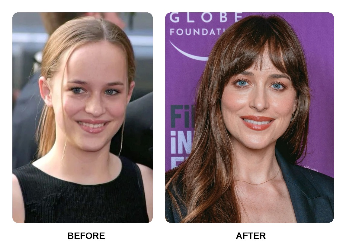 Dakota Johnson Teeth Before and After: What Happened in His Transformation?