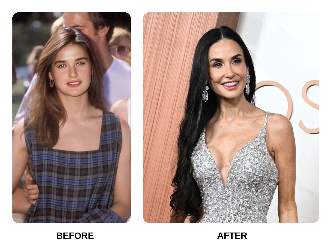 Demi Moore Teeth Before and After: What Happened in Her Transformation?