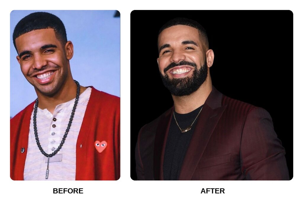 Drake Teeth Before and After: What Happened in His Transformation?