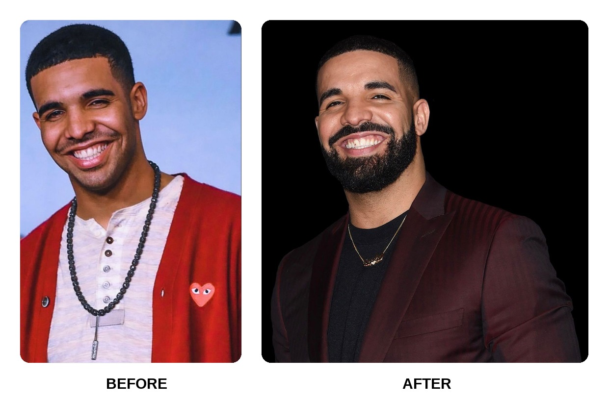 Drake Teeth Before and After: What Happened in His Transformation?