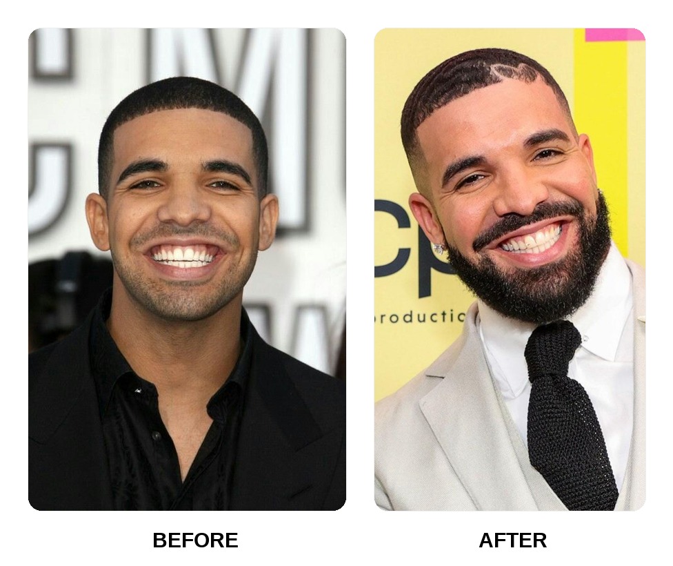 Drake teeth in his youth