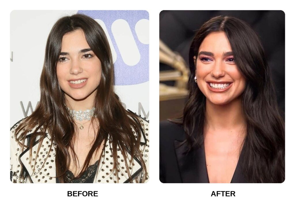 Dua Lipa Teeth Before and After: What Happened in Her Transformation?
